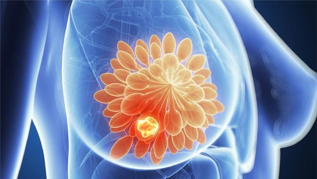 Biopsi VABB, Deteksi Dini Kanker Payudara Minimal Invasif dan Akurat