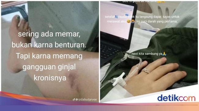 Viral Wanita Gagal Ginjal Kronis Diduga gegara Sering Minum Obat, Dokter Bilang Gini