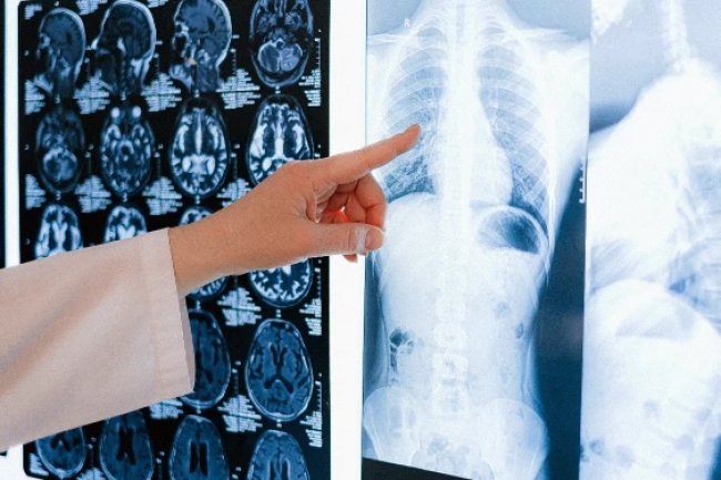 13 Gejala Kanker Paru Saat Mencapai Stadium Akhir