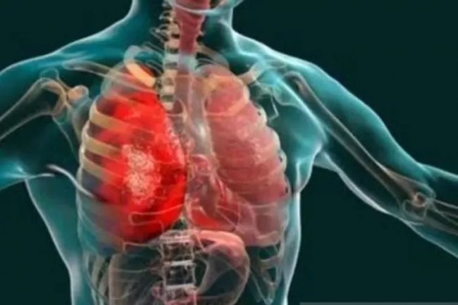 Dinkes Jogjakarta Tak Temukan Mycoplasma dari Ratusan Kasus Pneumonia