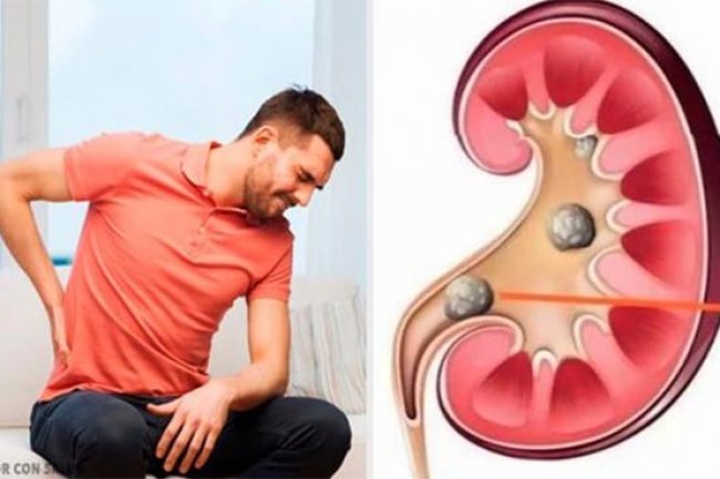 Sayangi Ginjalmu!, Beberapa Cara Sederhana Menjaga Kesehatan Ginjal