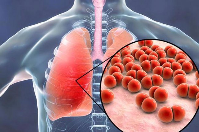Seberapa Jahat Mycoplasma Pneumoniae?