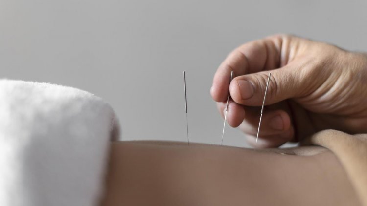 Sederet Manfaat Terapi Akupunktur bagi Penyintas Stroke, Salah Satunya Perbaiki Kemampuan Motorik