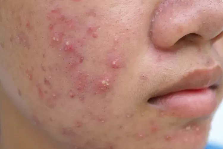 Dermatolog Ungkap Masalah Hormon Berpotensi Picu Munculnya Jerawat pada Perempuan Remaja