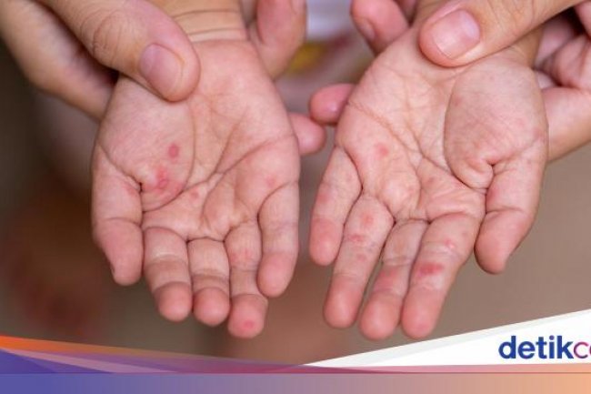 WHO Warning Kasus Campak Naik 30 Kali Lipat, RI Aman?