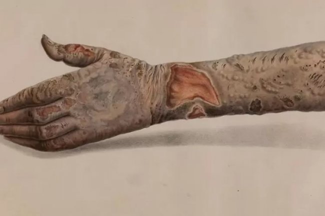 Sejarah Hari Kusta Internasional: Upaya Perawatan dan Pencegahan Penularan Penyakit Kusta