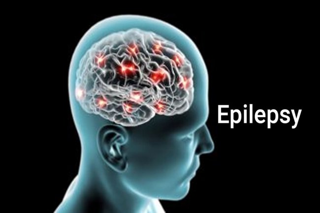 Sejarah Hari Ini, 12 Februari Memperingati Hari Epilepsi Internasional