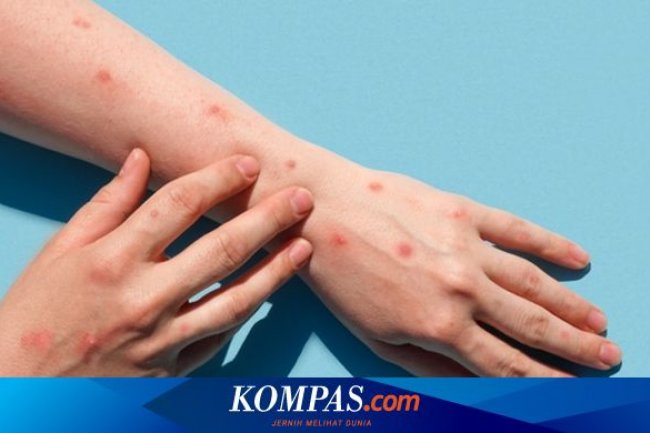 Apa Itu Wabah Mpox? Kenali Gejala dan Risiko Penularannya Berikut Ini