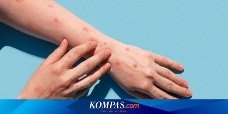 Apa Itu Wabah Mpox? Kenali Gejala dan Risiko Penularannya Berikut Ini