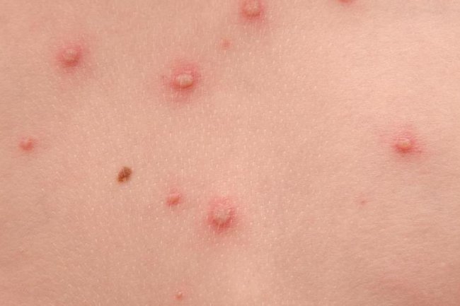 Kasus Cacar Air dan Gondongan Meningkat, Bagaimana agar Tak Tertular?