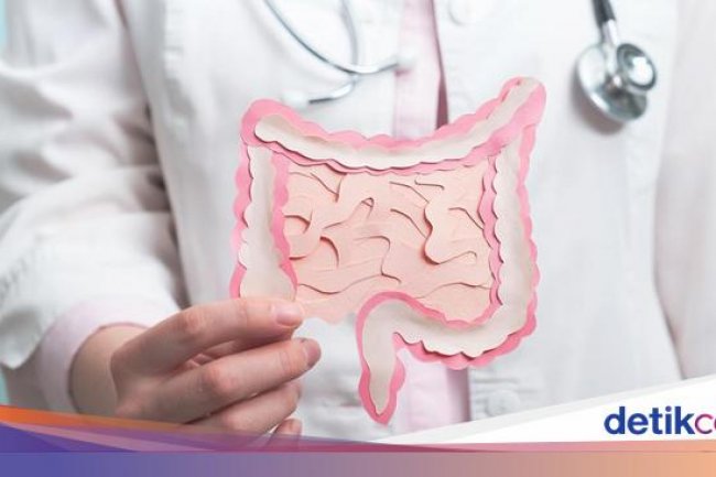 Kebiasaan Sehari-hari Ini Bisa Picu Kanker Usus di Usia Muda