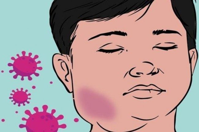 Penyakit Mumps atau Gondongan Viral di Tiktok, Mudah Menular dan Ini Cara Pencegahannya