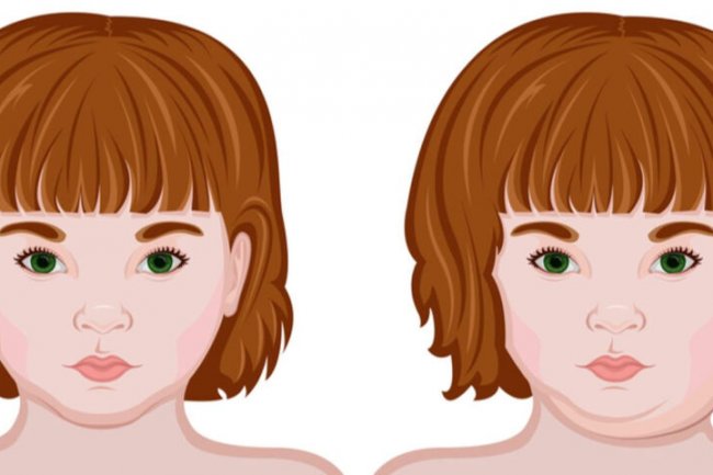 Bulan September Ada 172 Kasus Gondongen, Naik Daripada Bulan Agustus