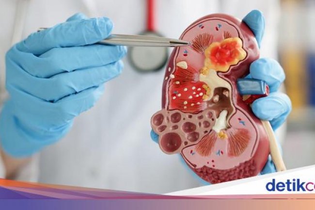 Tren Batu Ginjal di Usia Muda Meningkat, Waspadai Gejala yang Kerap Tak Disadari