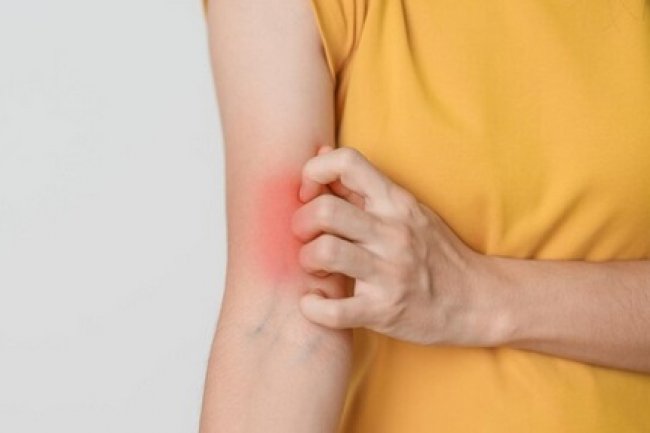 Kenali Tanda-tanda Lupus yang Perlu Kamu Curigai