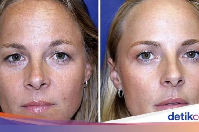 Saudari Kembar Ini Jalani Eksperimen Botox, Bisa Tebak Mana yang Melakukan?