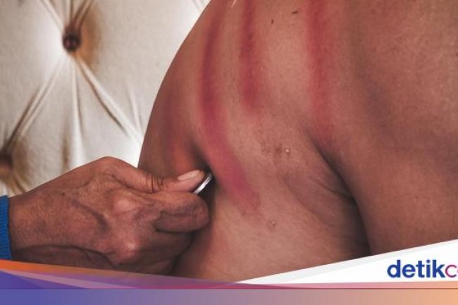 Terasa Enak Sehabis Kerokan? Lanjutkan, Ada Penjelasan Medis di Balik Sensasi Hangatnya