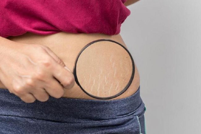 7 Cara Ampuh Hilangkan Stretch Mark, Bisa Gunakan Retinol Secara Rutin