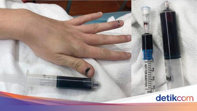 Viral Darah Wanita Berubah Jadi Biru Pasca Pakai Obat Sakit Gigi, Kok Bisa?