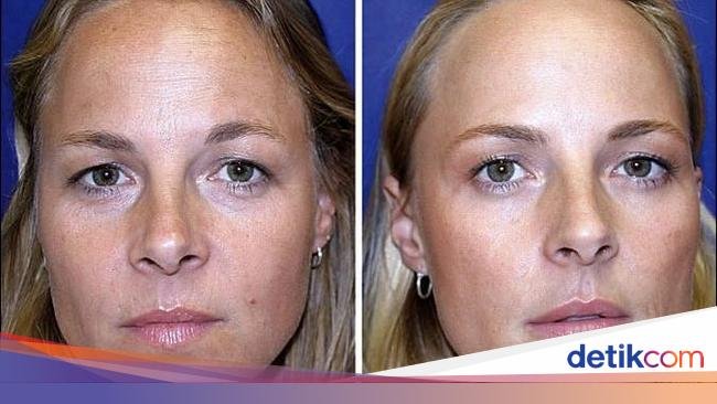 Saudari Kembar Ini Jalani Eksperimen Botox, Bisa Tebak Mana yang Melakukan?