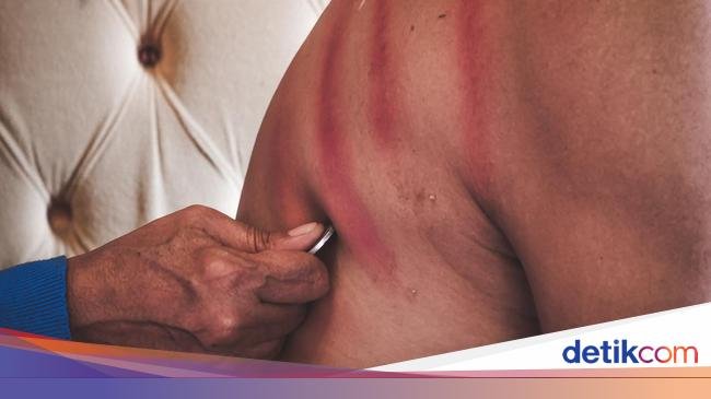 Terasa Enak Sehabis Kerokan? Lanjutkan, Ada Penjelasan Medis di Balik Sensasi Hangatnya