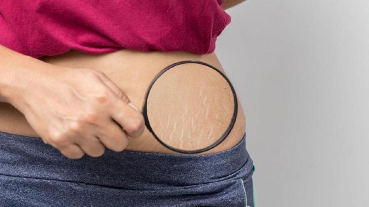 7 Cara Ampuh Hilangkan Stretch Mark, Bisa Gunakan Retinol Secara Rutin