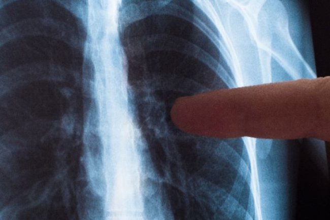 Penanganan TBC Disebut Masih Jauh dari Target