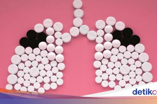 Ada 860 Ribu Kasus TBC di Indonesia, Ini Daerah yang Catat Temuan Terbanyak