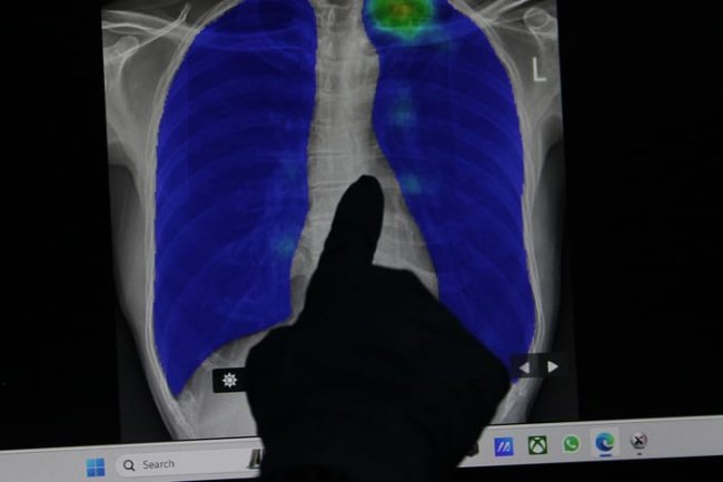 Kemenkes Akselerasi Pengentasan Tuberkulosis di 2025