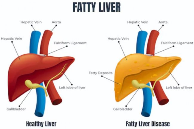 Dokter Ungkap 5 Tanda Awal Perlemakan Hati atau Fatty Liver
