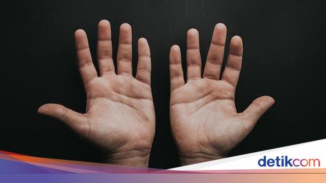 Telapak Tangan Mudah Berkeringat Gejala Punya Penyakit Jantung? Gini Kata Dokter