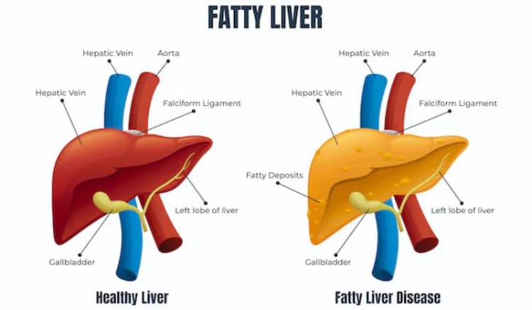 Dokter Ungkap 5 Tanda Awal Perlemakan Hati atau Fatty Liver