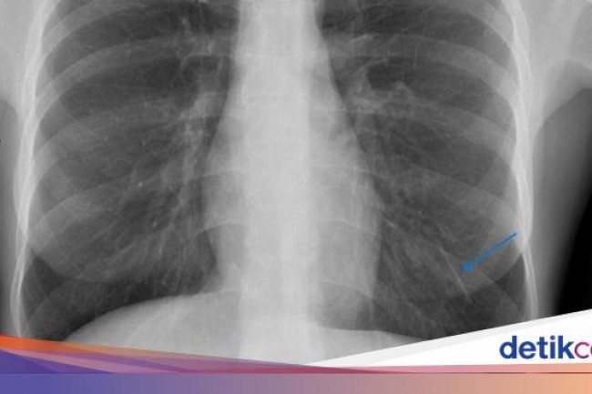 KB Implan di Lengan Mendadak Hilang, Tak Tahunya Nyasar ke Paru-paru