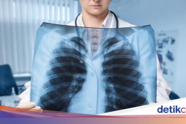 RI Catat Kematian Pneumonia Tertinggi pada 2024, Terbanyak di 5 Kelompok Ini
