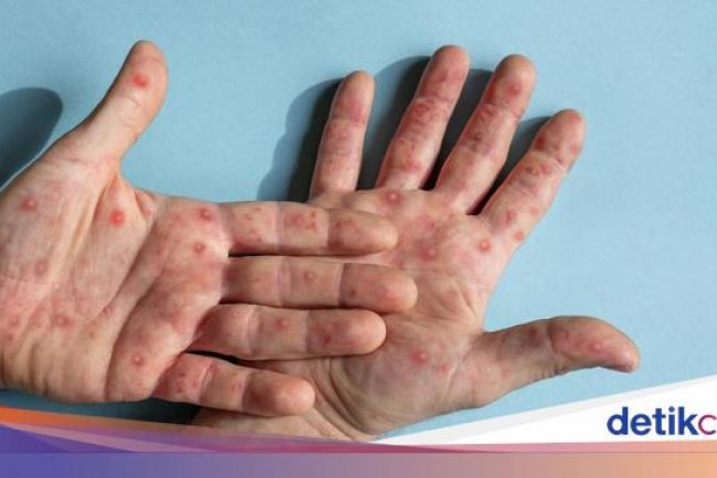 Kasus Campak di AS Meningkat, Vaksinasi Rendah Jadi Biang Keroknya