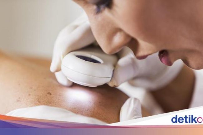 Muncul Bercak Seperti Ini di Kulit Bisa Jadi Tanda Kanker, Jangan Diabaikan