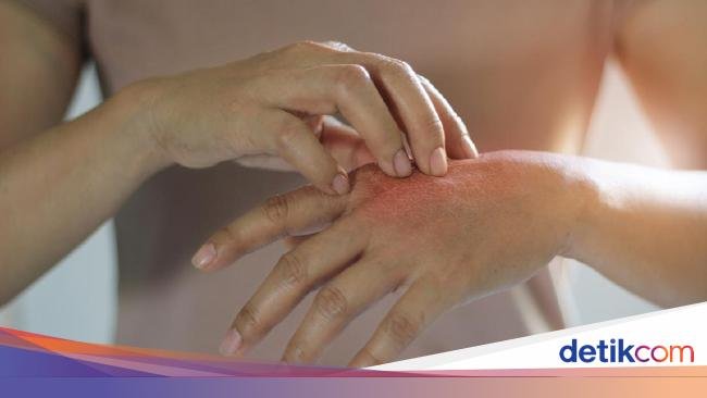 Kenapa Rasa Ingin Menggaruk Gatal Susah Dilawan? Ternyata Ada Manfaatnya