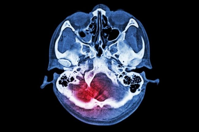 Ilmuwan Mengidentifikasi 10 Faktor Gaya Hidup Yang Terkait Dengan Risiko Dan Keparahan Stroke