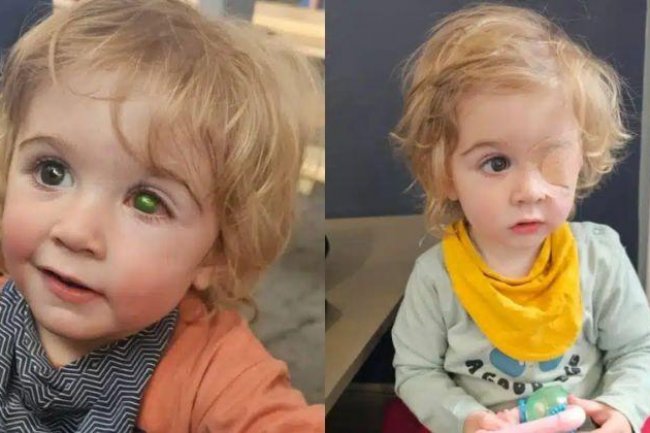 Seorang Anak Balita Alami Infeksi Mata karena Ciuman