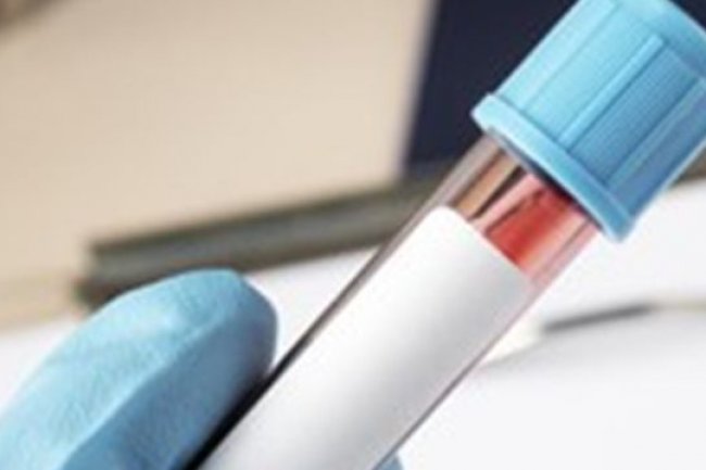 Waspada! Ini Penyebab Jumlah Sel Darah Putih Tinggi yang Perlu Diketahui