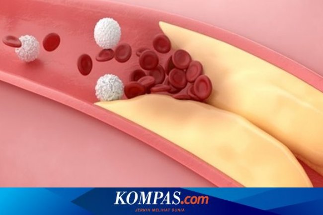 Kombinasi Dua Obat Penurun Kolesterol Bisa Selamatkan Ribuan Nyawa
