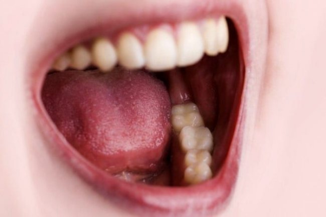 ADR Pasca Vaksinasi COVID-19 pada Rongga Mulut - Universitas Airlangga Official Website