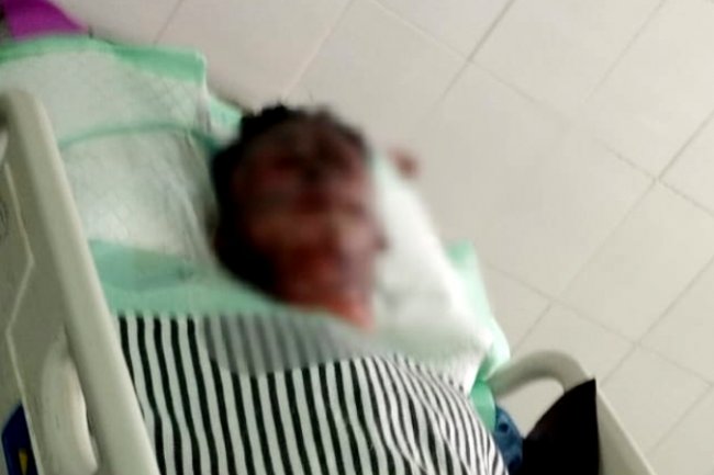 Petasan Meledak, Pemuda di Gresik Alami Luka Bakar