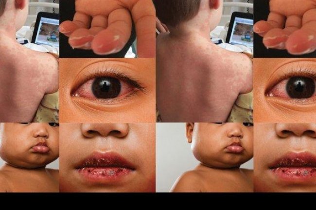 Penyakit Kawasaki Serang Anak Dibawah Lima Tahun, bisa Parah Kena Jantung