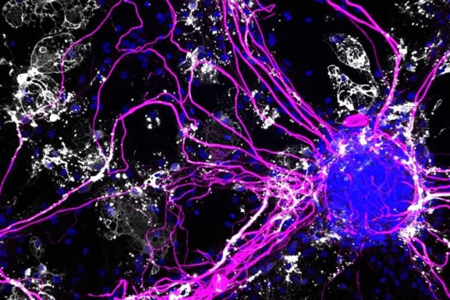 Sepotong Teka -teki -teki Alzheimer Ditemukan: Pemicu Peradangan Yang Dapat Mempercepat Demensia