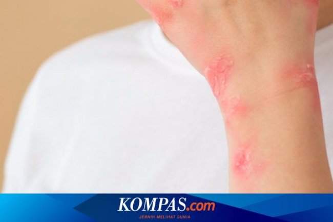 Sudah Pernah Kena Campak, Perlu Vaksin Lagi? Ini Penjelasan Dokter