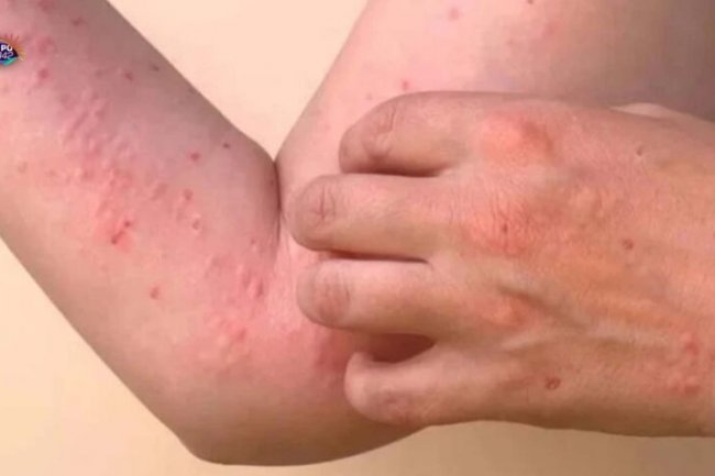 Pasca Lebaran, Ada Indikasi Banyak Warga Kena Chikungunya, Permintaan Obat di Apotek Naik 15 Persen