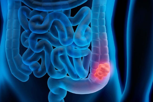 Kanker Kolorektal Banyak Diidap Gen Z, Bagaimana Gejalanya?