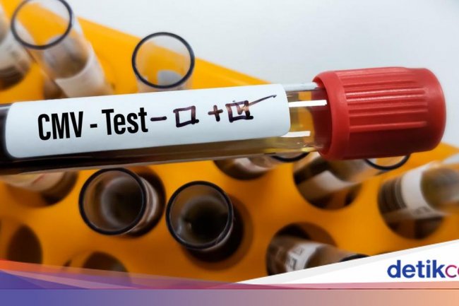 Infeksi Virus CMV Berpotensi Memperburuk Gejala Autisme