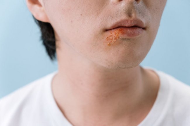 Vaksin herpes zoster beri efek jangka panjang pada kesehatan jantung